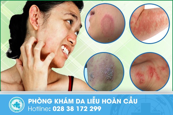 Dấu hiệu bệnh da liễu 