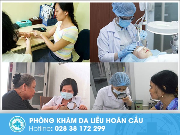 xơ cứng bì dạng mảng