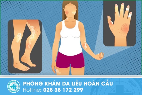 bệnh xơ cứng bì toàn thể