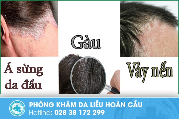 Hình ảnh miêu tả bệnh á sừng, gàu và vảy nến