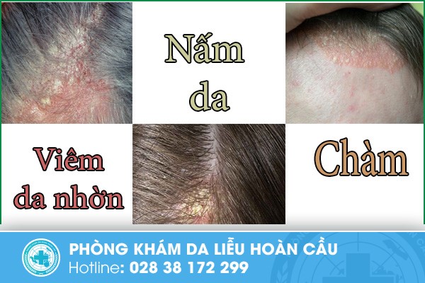 Hình ảnh về viêm da nhờn, nấm da và chàm bội nhiễm