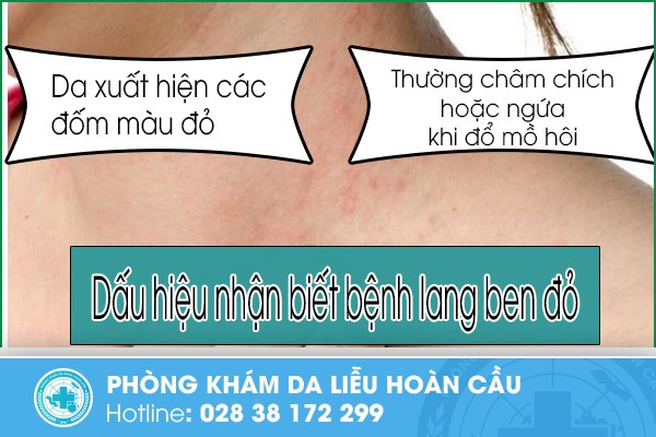 Những dấu hiệu nhận biết mắc bệnh lang ben đỏ