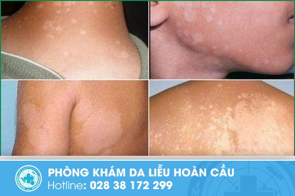 Hình ảnh về bệnh lang ben trắng