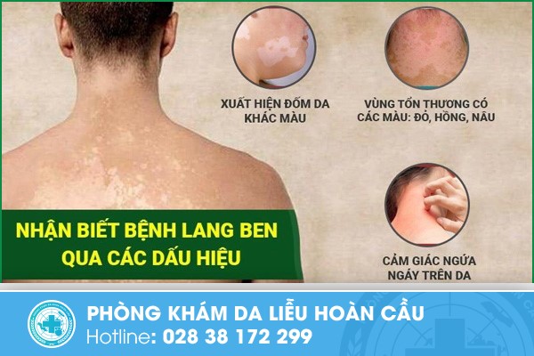 Dấu hiệu nhận biết bệnh lang ben trắng