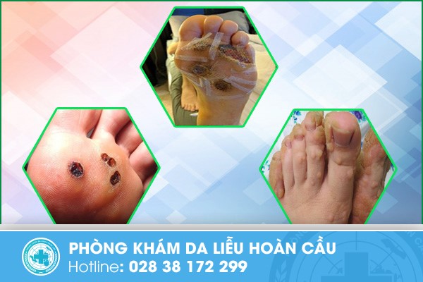 Tự xóa mụn cóc tại nhà gây nhiều biến chứng nguy hiểm 