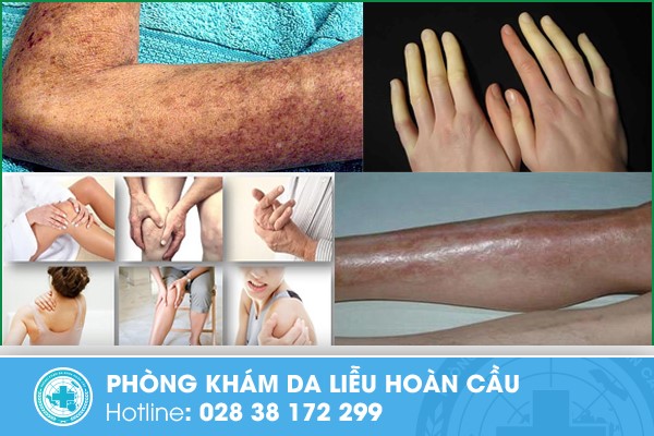 Biểu hiện bên ngoài của bệnh xơ cứng bì