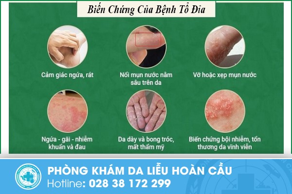 lòng bàn tay ngứa nổi hột