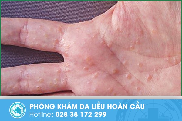 Lòng bàn tay ngứa nổi hột có thể là do bệnh tổ đỉa