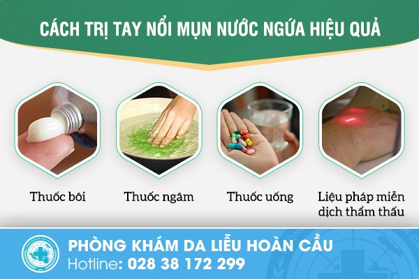 Các phương pháp điều trị tay nổi mụn nước được nhiều chuyên gia hàng đầu khuyên dùng