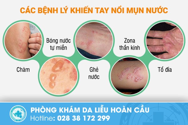 Tay nổi mụn nước là biểu hiện của bệnh gì?