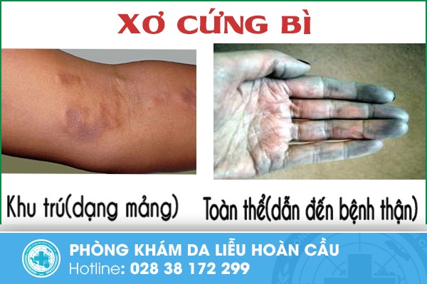 Hình ảnh bệnh xơ cứng bì