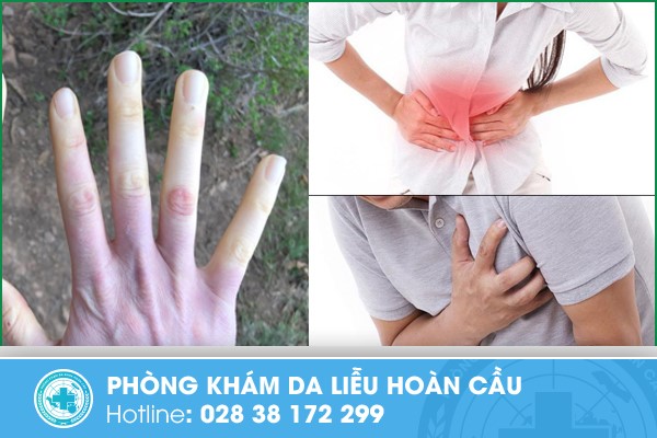 Những triệu chứng biểu hiện bệnh xơ cứng bì