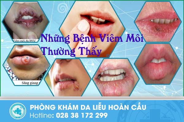 Những bệnh viêm môi thường thấy