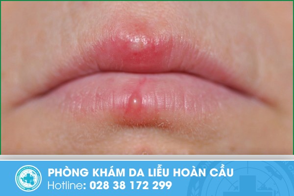 xăm môi nổi mụn nước