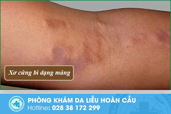 xơ cứng bì dạng mảng